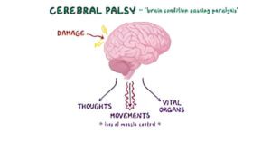 Cerebral Palsy