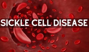 Sickle Cell Disease
