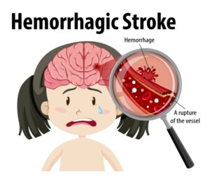 Hemorrhagic Stroke