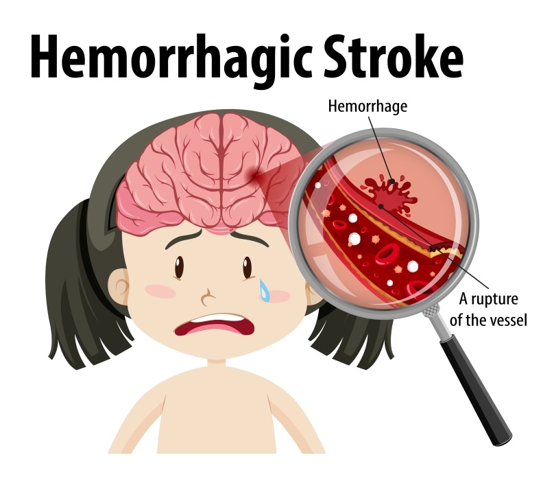 Hemorrhagic Stroke